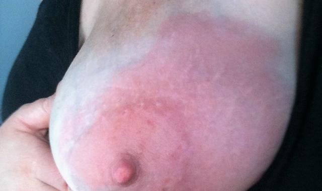 Mastitis (Breasts Infection) – Reasons, Signs & Remedies